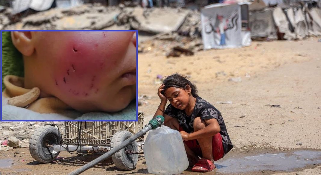 ঘুমন্ত শিশুর গালে ইঁদুরের কামড়